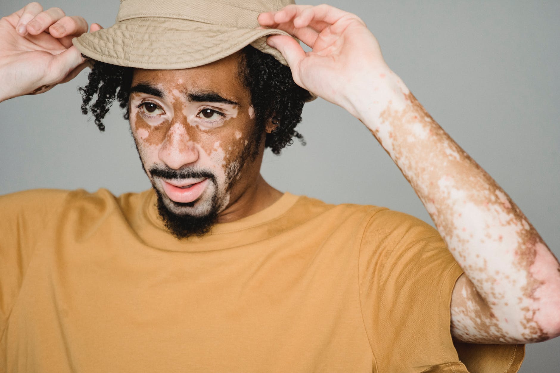 man with vitiligo touching hat